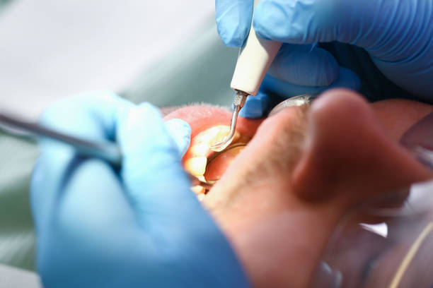 Best Emergency Tooth Extraction in Judson, SC